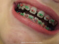 cute color braces
